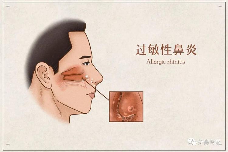 孩子反复发烧鼻子轻微出血