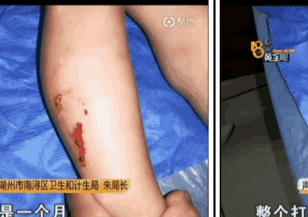 男孩狗咬身亡