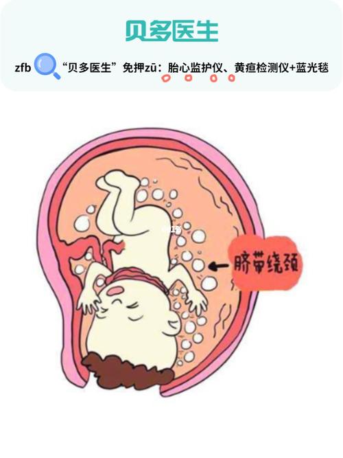 什么动作会导致脐带绕颈