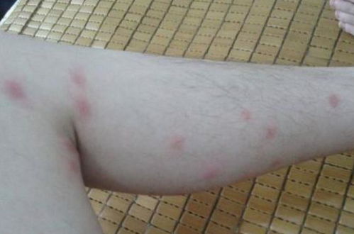 职场新人必读被毒蚊子咬了怎么办？