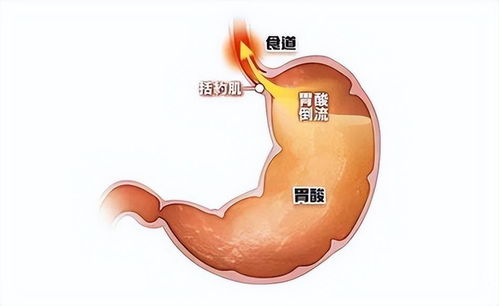 反流性食管炎，宝宝的常见症状与应对策略