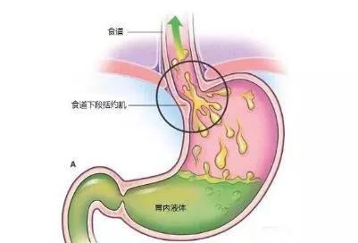 反流性食管炎，宝宝的常见症状与应对策略