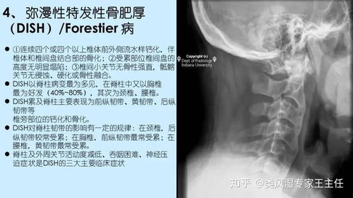 强直性脊柱炎，了解并管理这一疾病的并发症