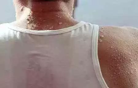 错用药物之痛，男孩拍打隐翅虫后的悲剧与警示