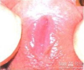 非淋菌性尿道炎的症状及其对儿童的影响