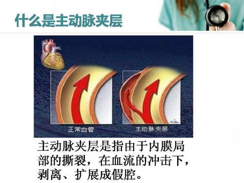 32岁网红直播背后的警钟，突发脑溢血的警示与反思