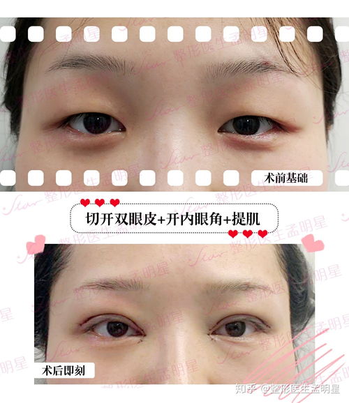 医疗失误之痛，四岁女童双眼手术之谜