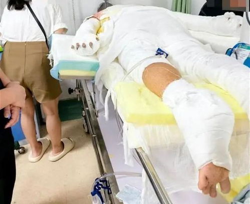 医生回应烧伤妈妈钢丝球清创，专业操作与公众误解的深度解析