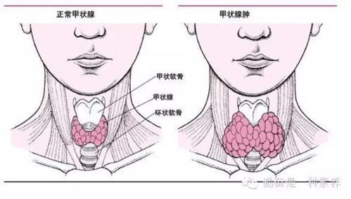 甲状腺炎的治疗与家庭护理指南