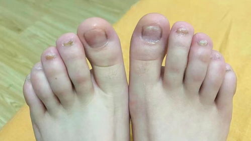面对儿童灰指甲，家长应如何正确应对？