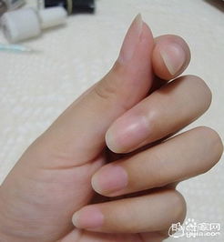 面对儿童灰指甲，家长应如何正确应对？