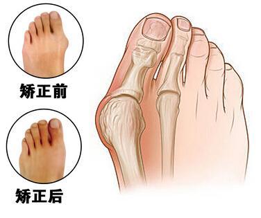 脚外翻矫正，了解、预防与治疗