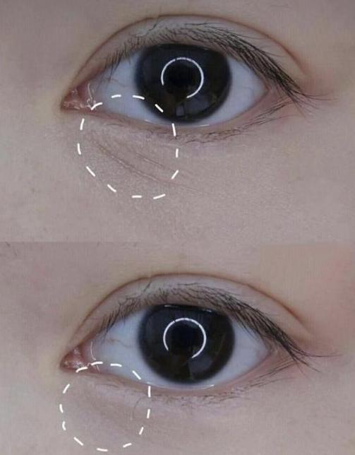 告别眼角细纹，重拾年轻光彩——轻松去除眼角细纹的秘诀