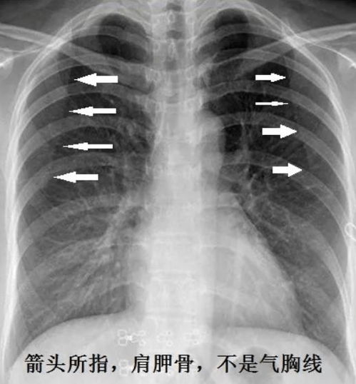 气胸，不可忽视的胸部急症