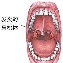 扁桃体化脓，症状、原因与科学应对方法