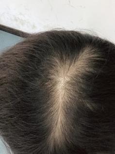 头发掉得好厉害怎么办？全面解析脱发原因与应对策略