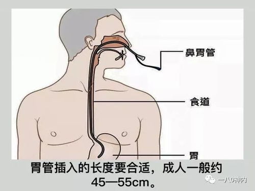 胃管喂养，了解适合通过胃管输送的食物