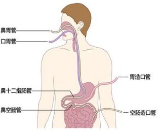 科学喂养，掌握打胃管流食的正确方法