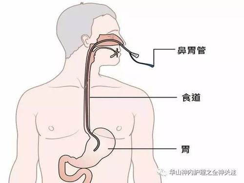 科学喂养，掌握打胃管流食的正确方法