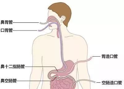 为使用胃管的病人选择最佳饮食，营养与安全并重