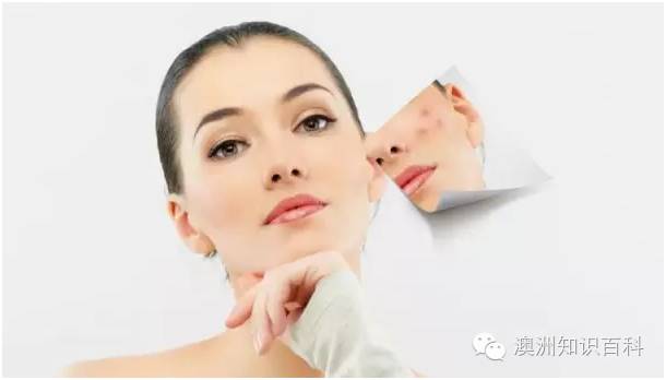 下巴长痘怎么办？告别反复困扰的成人痘痘全攻略
