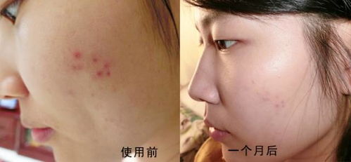 下巴长痘怎么办？告别反复困扰的成人痘痘全攻略