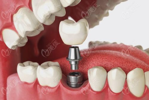 口腔医学技术：揭秘牙齿修复如何实现无痕美观与功能重建的完整指南