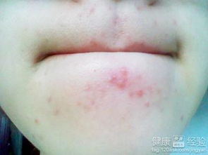 下巴长痘痘的原因揭秘：告别反复困扰，轻松拥有清爽下巴