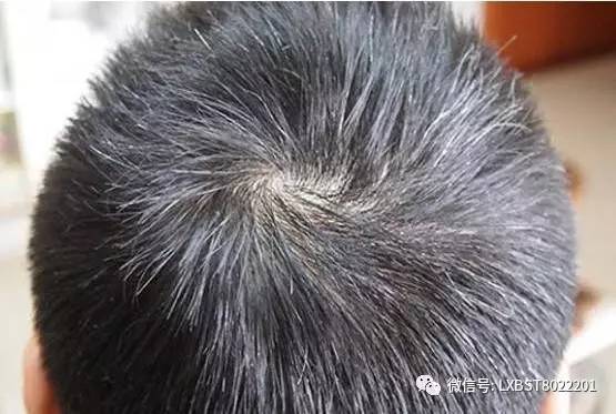 如何让头发长得快？这15个天然方法让发量暴增不再掉发